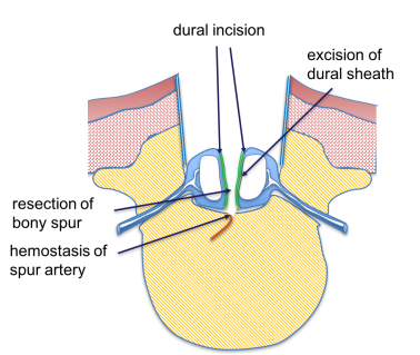 resection of sheath